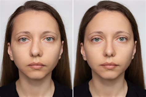 fix asymmetrical face fix asymmetrical face naturally