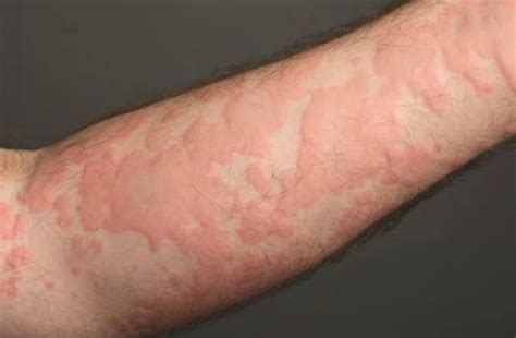 O Que Significa Urticária - O que é Urticária? | Dermatolaser