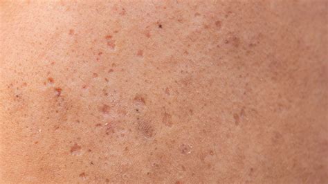 Revitalising Dull Skin: Common Triggers and Effective Solutions