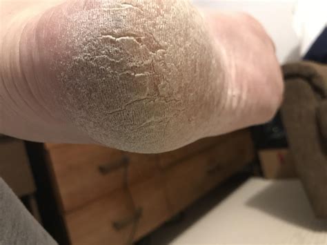 What Lotion Is Good For Dry Cracked Feet at Lester Mitchell blog