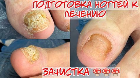 Зачистка ногтя при кератозе 🍄 Подготовка ногтей перед лечением - YouTube