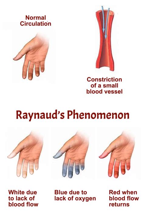 Raynaud’s Phenomenon | APS Foundation of America, Inc.