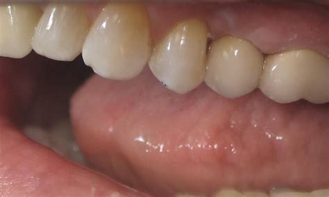 crown  implant crown restoration    st louis