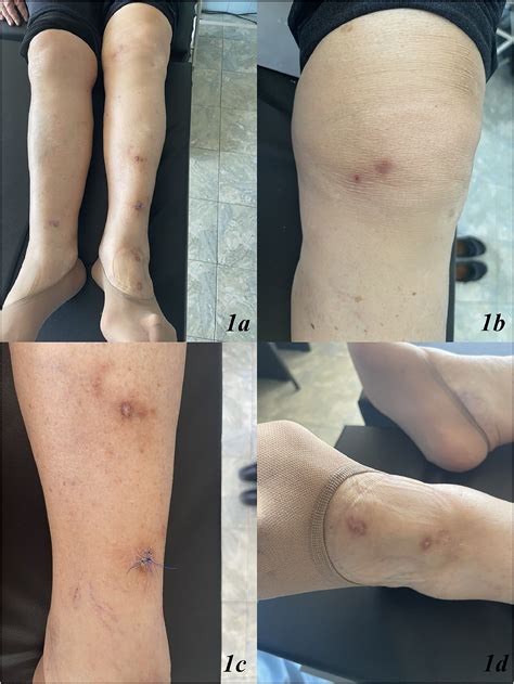 Erythema Nodosum Legs