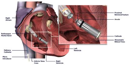 The Medtronic Micra Leadless Pacemaker | Dr Oliver Segal