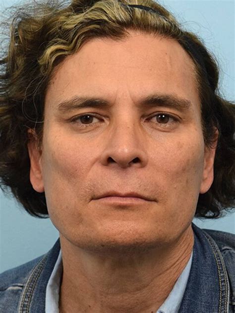 botched fat grafting face 14