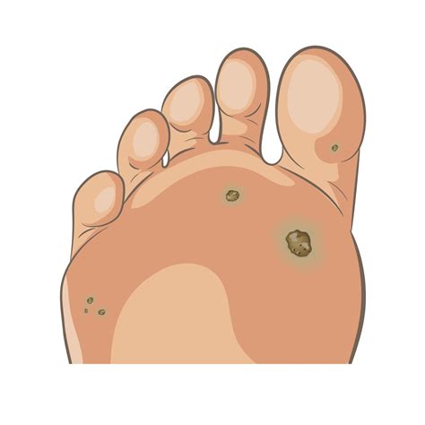 Foot wart. Foot bottom pathology, verruca, wart, papilloma virus. Many