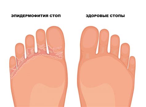 Микозы (грибковые поражения) в Тюмени, цены, клиника косметологии ...