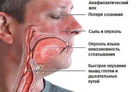 Анафилактический шок