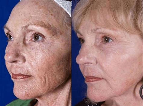 Co2 Laser Fracionado Antes E Depois - Antes e Depois do Laser CO2 Fracionado Renovação da Pele