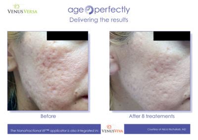 Venus Viva: Facial Remodeling & Resurfacing | Age Perfectly