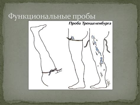 Варикозное расширение вен нижних конечностей - презентация онлайн