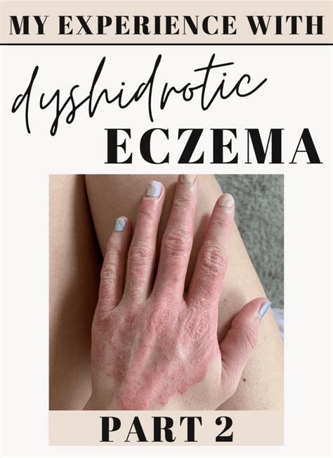 hand dyshidrotic eczema dyshidrose  nysnib