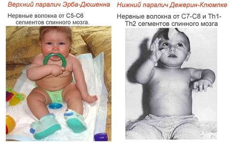 Родовые травмы новорожденных. Кефалогематома. Родовые травмы ЦНС ...
