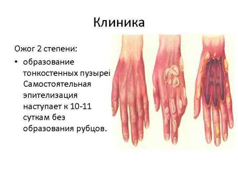 Термические химические и лучевые ожоги