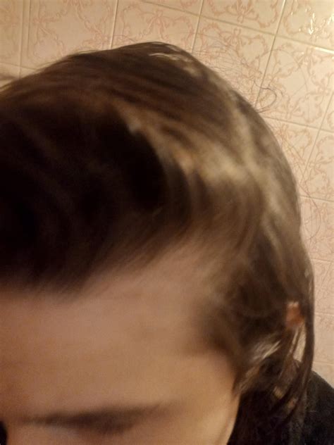 Am I thinning on the sides or is this normal? What can I do to make my