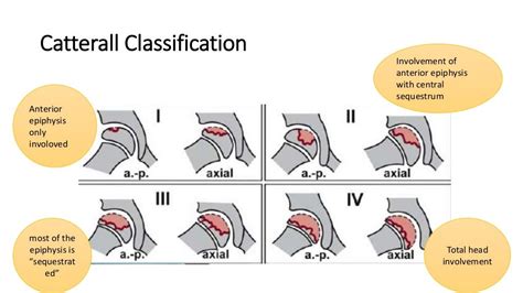 Perthes disease