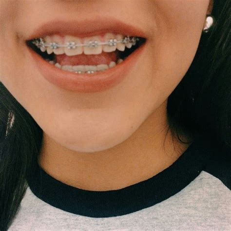 Braces ideas with purple elastics – Artofit