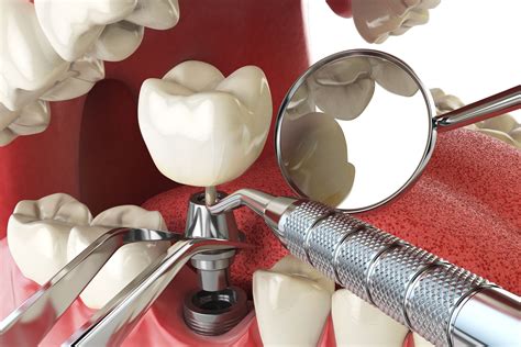 Dental Implants Procedure: A Step-by-Step Guide - Greater Essex Dental