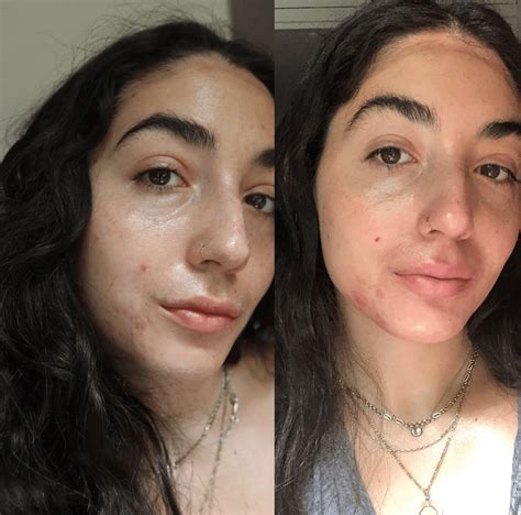 My Accutane journey and experience with isotretinoin • BREAKEVEN