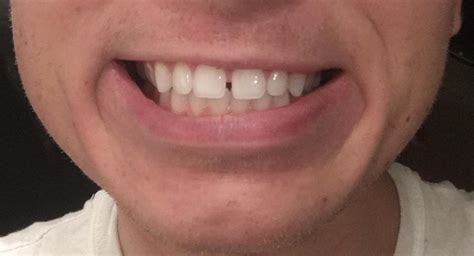 Best way to fix this tooth gap? Invisalign? Veneers? Bonding? : r/Teeth