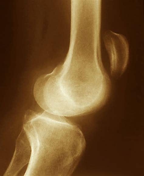 Image:Patellar Tendon Tear-Merck Manual Professional Edition