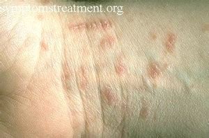 Pictures of Scabies, Crusted, Mite, Symptoms, Treatment