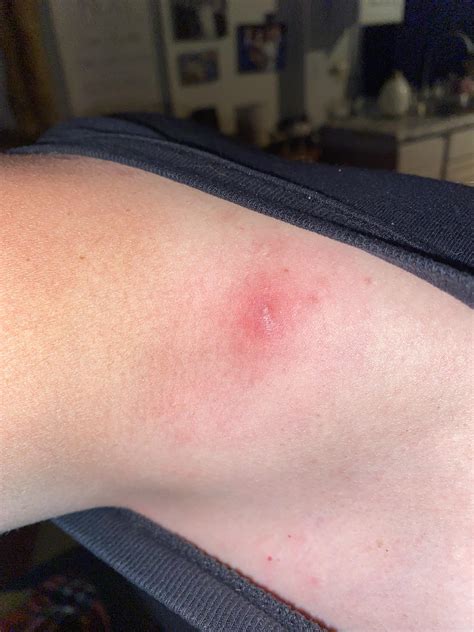 ive  lyme disease    treating    year