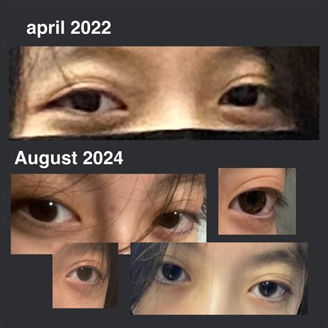 eyelids moving upwards ever so slightly. how do i revert? is it because