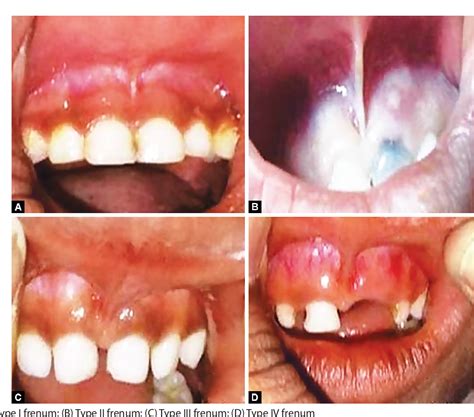 Maxillary Labial Frenum | Semantic Scholar