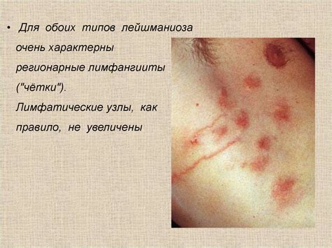 Кожный лейшманиоз - online presentation