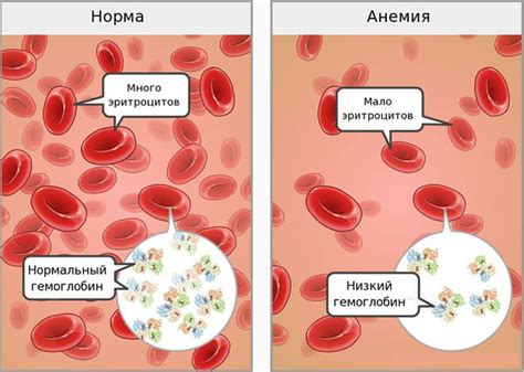 Железодефицитная анемия (ЖДА): причины, симптомы и лечение в статье ...