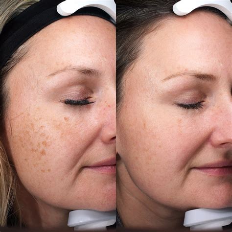 how to get rid of aging spots on face