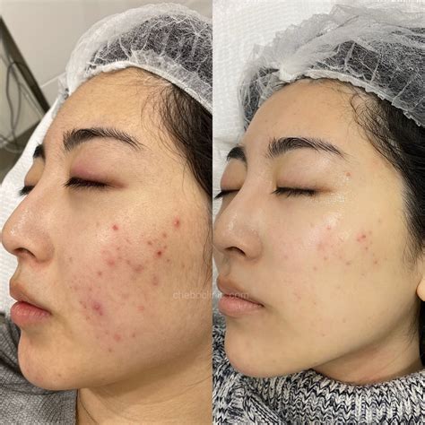 kp treatment for face 2