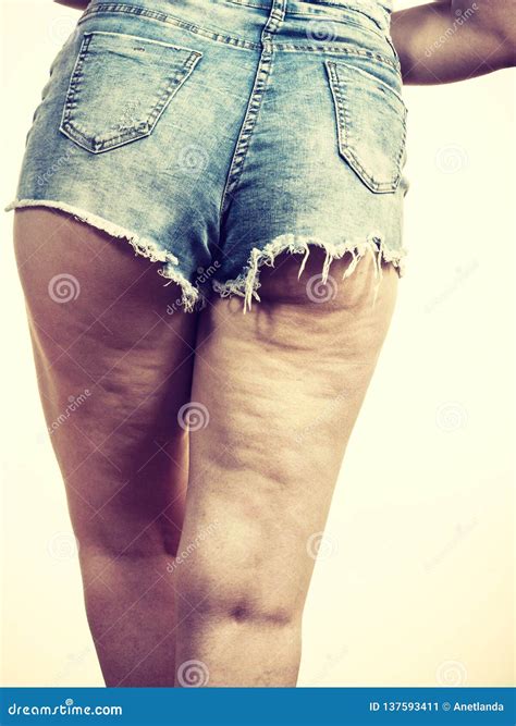 Woman Legs with Cellulite Skin Stock Image - Image of cellulite, body