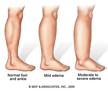 Linguistique janvier rincer leg swelling reasons Hubert Hudson geste ...