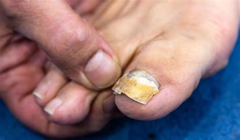What Kills Toenail Fungus Instantly? Fastest Remedies