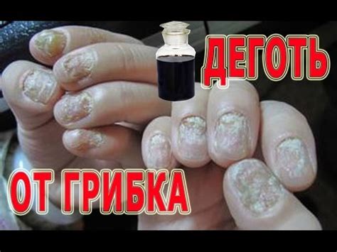 ★Деготь березовый для лечения грибка. Рецепт мази с дегтем для лечения ...