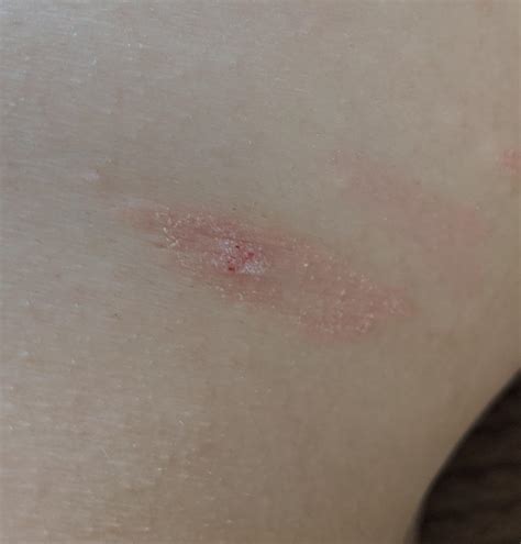Is this Pityriasis rosea? (Herald patch on side) : r/DermatologyQuestions