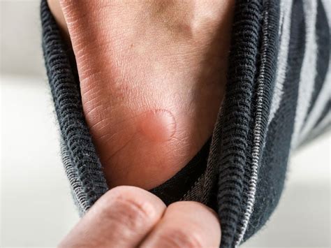 Water Bumps On Hands