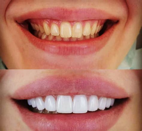 veneers cosmetic teeth cosmetic dentistry veneers veneers teeth