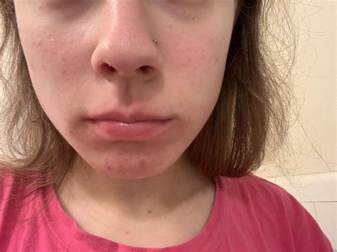 Butterfly Facial Rash Causes