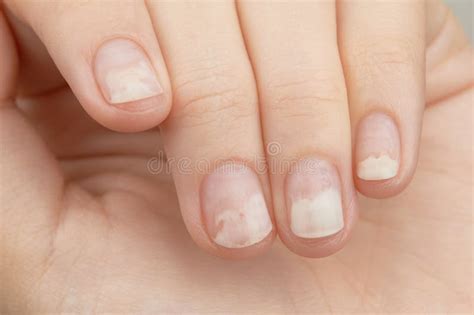 Fingernails with Onycholysis after Removing Gel Polish. Womans Hands ...