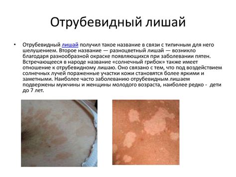 Болезни кожи - презентация онлайн