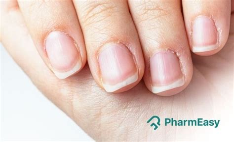 Aggregate more than 156 iron deficiency anemia nails latest - in.coedo ...