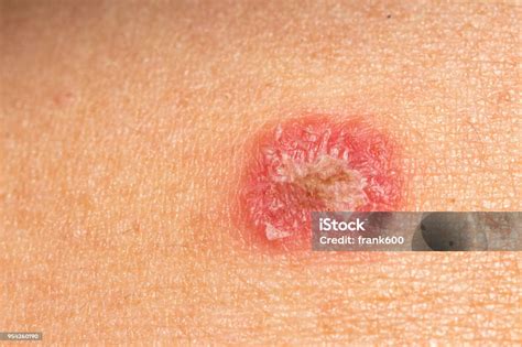 infeksi kurap dermatophytosis  kulit foto stok  gambar