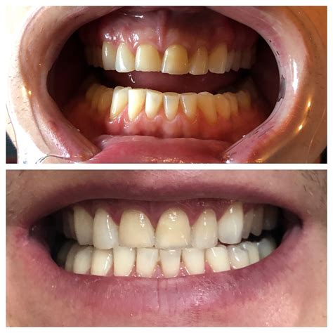 Before & After — Honey Bunz Airbrush Tanning