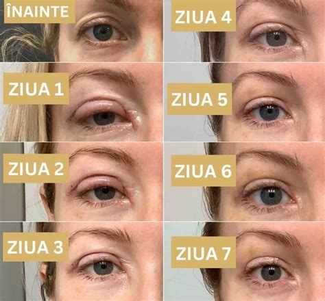 Așa ai parte de cea mai bună recuperare după blefaroplastie ️ Clinica ...
