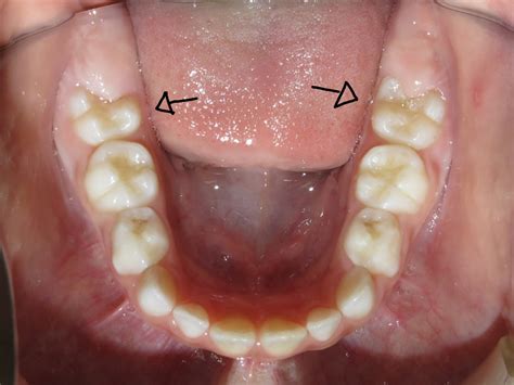 Primeiro Molar Permanente Nascendo - Ortodontia.com.Borel: Primeiro molar permanente.