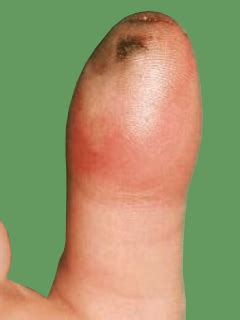 Felon – Infection of the Fingertip Pulp – Fife Virtual Hand Clinic